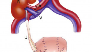 Tumori urologici, ogni anno 87mila nuovi casi in Italia