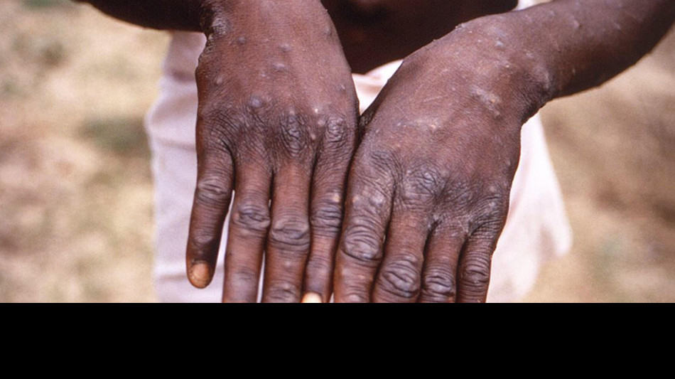 Infezioni sessualmente trasmissibili tornano emergenza sanitaria