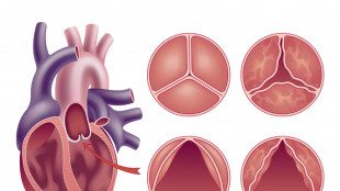 Stenosi aortica, la prima valvola si sceglie pensando gi&agrave; alla seconda
